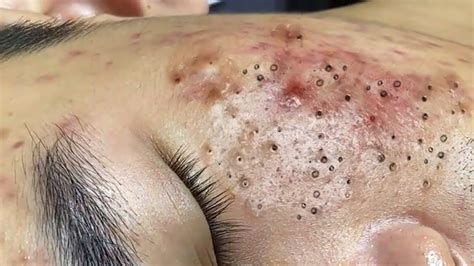 acne removal videos.